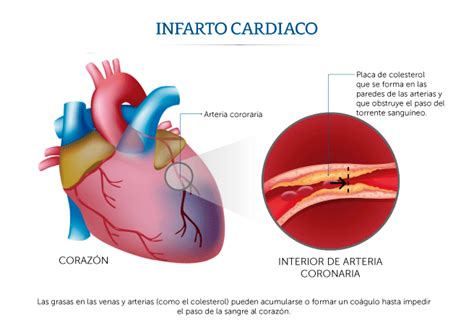 Médica Sur ¿qué Es Un Infarto Cardiaco