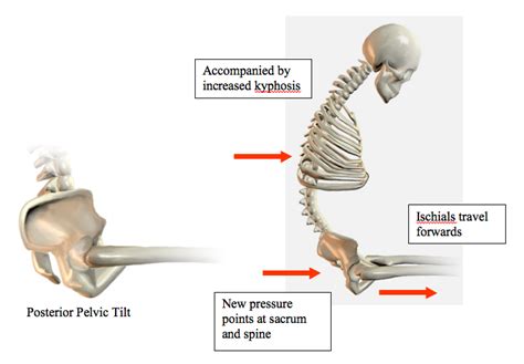 Practical Seating Considerations – Posterior Pelvic Tilt | Pelvic floor