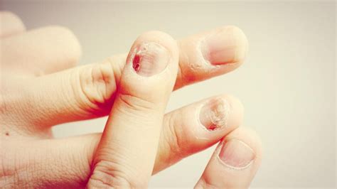 Nail Psoriasis Vs Fungus Whats The Difference TheWellthieone