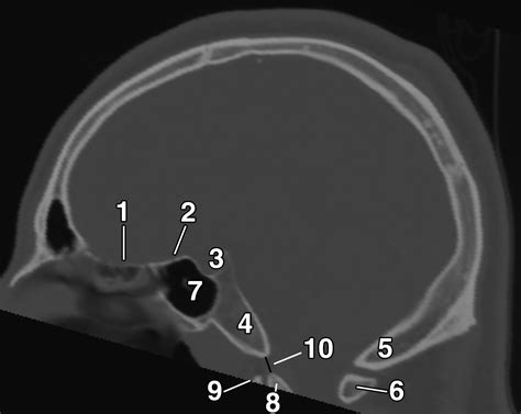 Skull Baserelated Lesions At Routine Head Ct From The Emergency