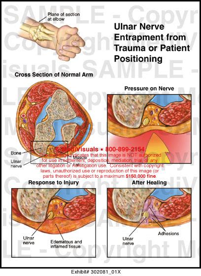 Ulnar Nerve Entrapment From Trauma Or Patient Positioning Medivisuals
