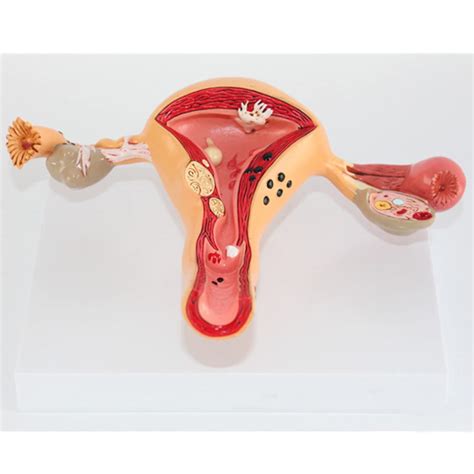 Buy VISTANIA Pathological Uterus Ovary Anatomical Model Uterus