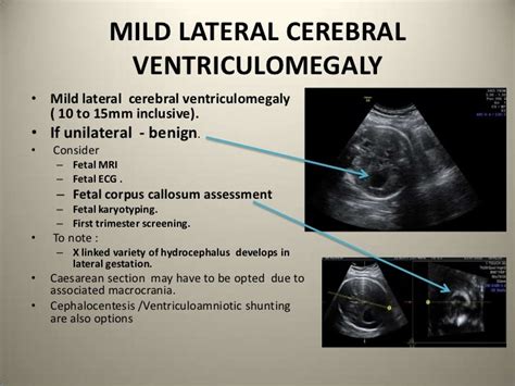 Congenital Lateral Ventriculomegaly