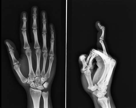 Swan Neck Deformity Hand Orthobullets