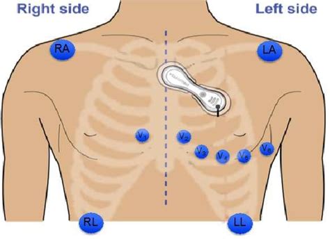 Electrode Placement Layout Of Holter Monitor Blue Electrodes Are For