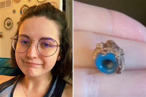 Woman Blows Out Giant Booger 20 Years After Bead Stuffing Incident