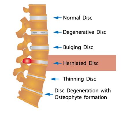 Herniated Disc Causes Symptoms Treatments Ainsworth Institute
