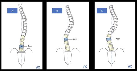 Surgical Correction Of Lenke 1c Adolescent Idiopathic Scoliosis