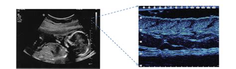 Non Invasive Ultrasound Imaging Of Soft Tissue Clinically Assess My