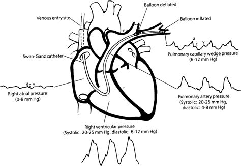 The Pulmonary Artery Catheter Cardiology Clinics