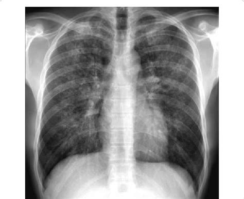 Chest Radiography In A Patient With Absolute Neutrophil Count