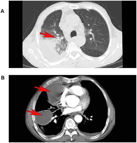 First Lung Ct Scan Slight Exudation Interstitial Changes And