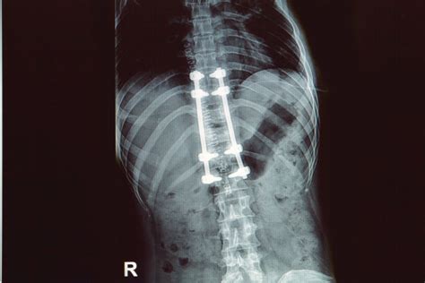 What To Do After A Failed Spinal Fusion Surgery Dr Sinicropoi