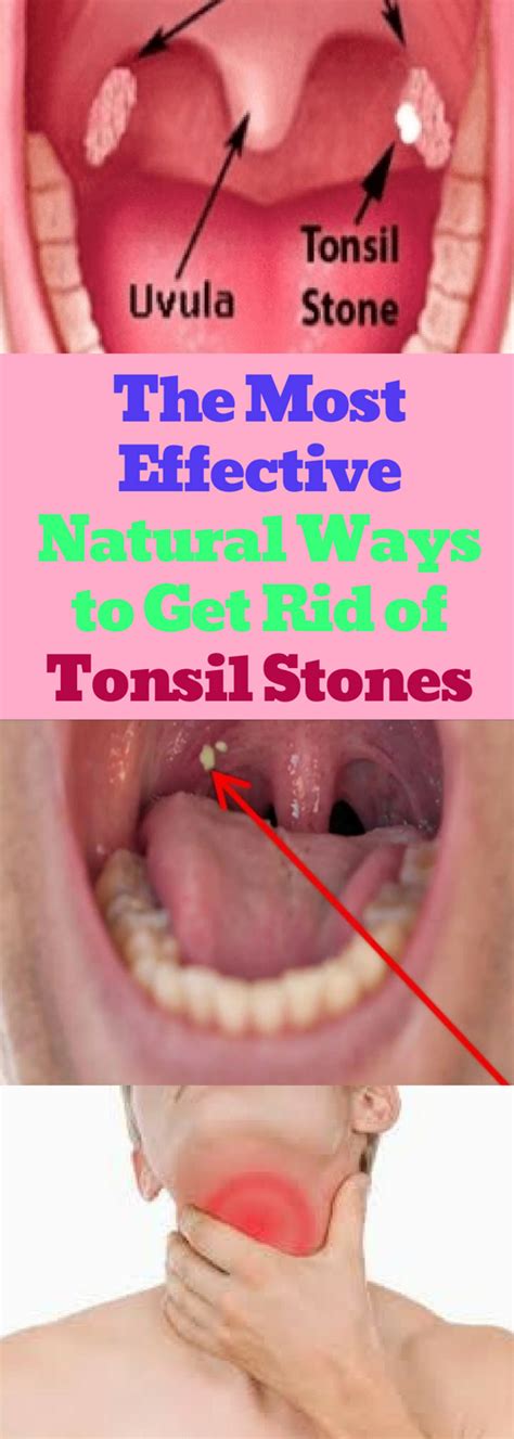 How To Remove Tonsil Stones From Throat How To Do Thing