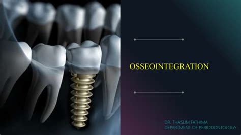 Osseointegration Bone Bonding With Dental Implants Ppt