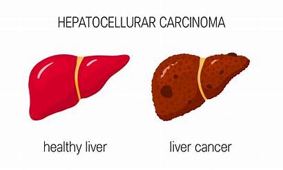 Cancer Hepatocellular Liver Carcinoma Hcc Concept Fegato
