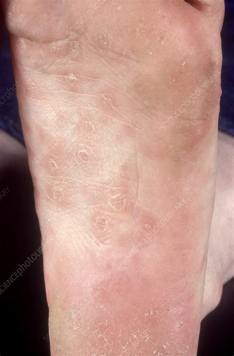 Skin Rash In Secondary Syphilis Stock Image C0559828 Science