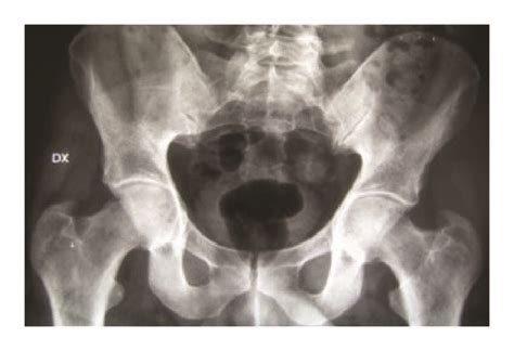 Ap X Ray Of The Pelvis Detects Acetabular Protrusion In A 36 Year Old