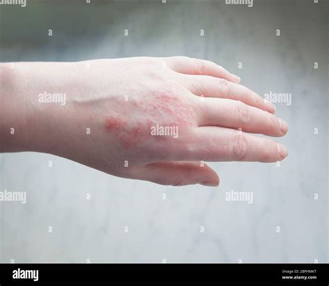 Hand Closeup Skin Disease Psoriasis Stock Photo Alamy