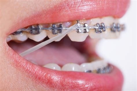 Orthodontic patient compliance | UK Adult Braces