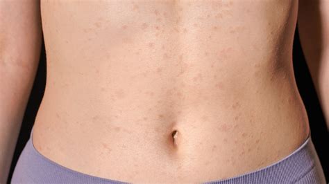 The Acne On Your Stomach Could Be Something Else