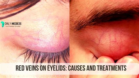 Red Veins On Eyelids Causes And Treatments Daily Medicos