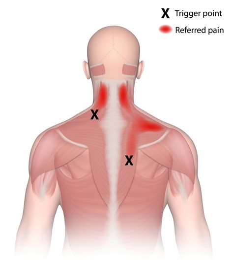 Trigger Point Injections In Sinking Spring And Reading Pa Smith Chiropractic And Wellness Center