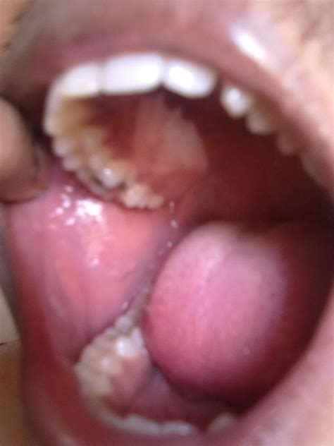 Ent Surgeons Blog Regarding Oral Lichen Planus