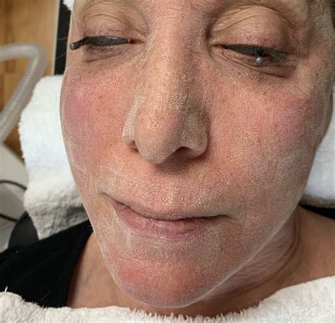 Review Fractional Co2 Laser