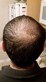 Finasteride No Sides Pictures