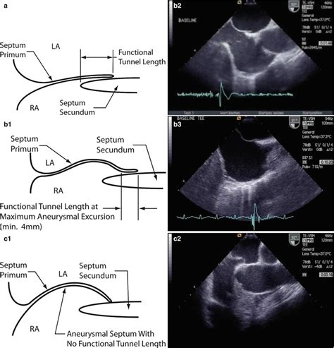 Anatomical Variations Of Patent Foramen Ovale Thoracic Key