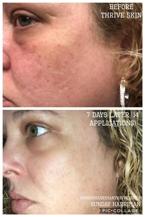 Pin By Sunday Harriman On Thrive Skin Before And After Results Health