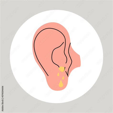 Fluid Draining From The Ear Otitis Tinnitus Symptom Bacteria In The