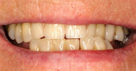 Common Denture Problems And How To Solve Them 42 Off