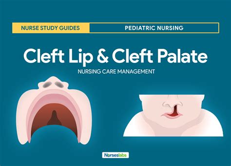 Cleft Lip And Cleft Palate Nursing Care Management