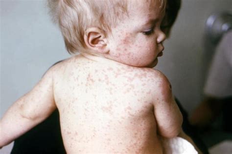 Measles Mumps Rubella Vaccine Wyandot County Public Health