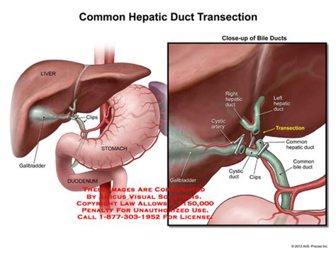 Amicus Illustration Of Amicus Surgery Hepatic Ducts Transection Liver