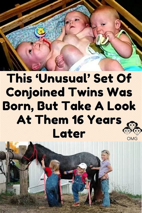 Funny Love Really Funny Memes Conjoined Twins Thing 1 Weird Facts