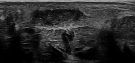 Musculoskeletal Joints And Tendons 68 Foot Case 6812 Plantar Fibromas Ultrasound Cases