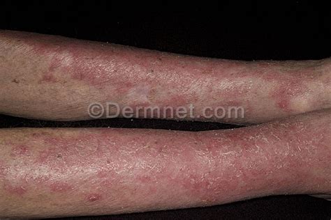 Leg Eczema Treatment Dorothee Padraig South West Skin Health Care