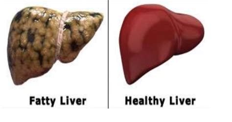 Liver Detoxification The Signs And Steps To Check Health Beauty