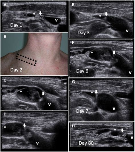 Lymph Vessel Thrombus Detection In Cervical Lymphedema A Case Series