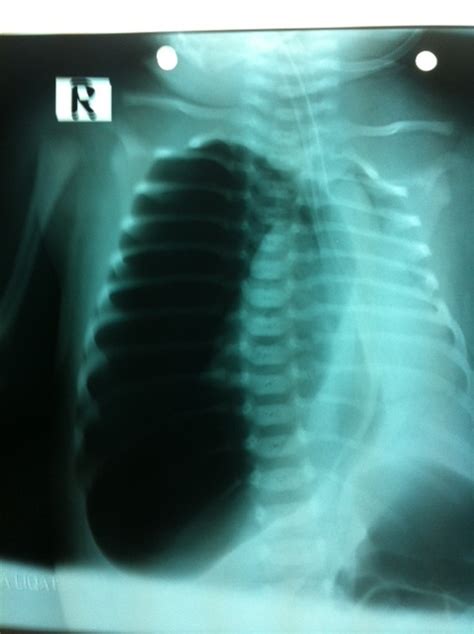 Single chamber underwater seal chest drain. 1000+ images about CLINIPICS on Pinterest