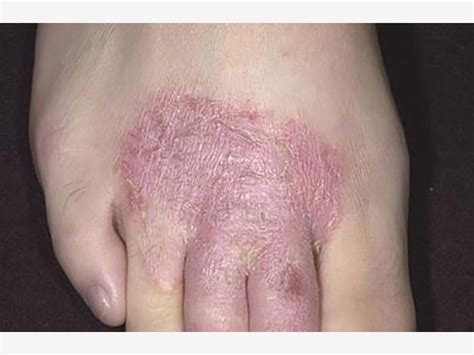 Eczema In Picturesmild To Severe Eczema Eczema Living
