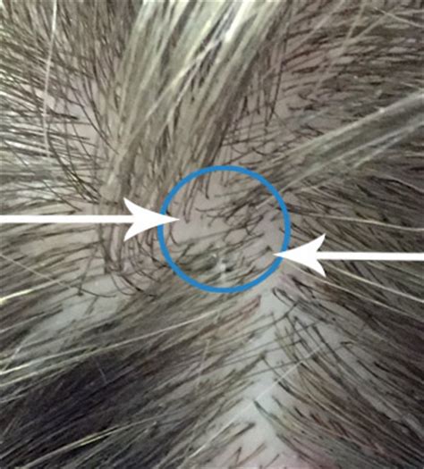 Why Do I Have Two Hairs Growing From The Same Follicle