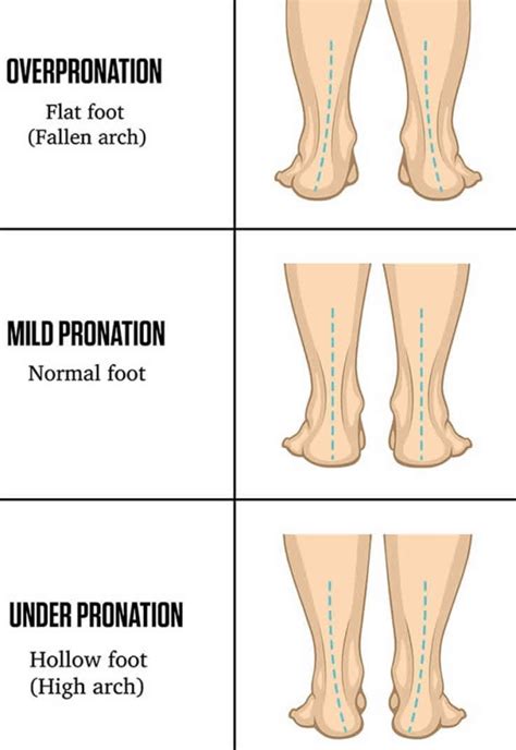 Dr Cs Journal Flat Feet And Overpronation Doctors Without Waiting