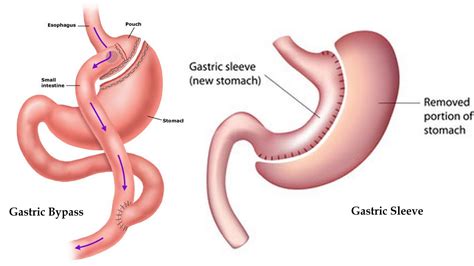 Sleeve Gastrectomy Versus Roux En Y Gastric Bypass A Retrospective My