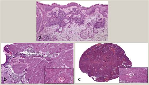 An Overview Of Hair Follicle Tumours Diagnostic Histopathology