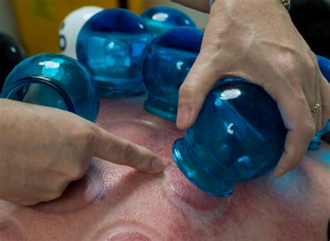 cupping in dubai traditional chinese medicine chinese medical center