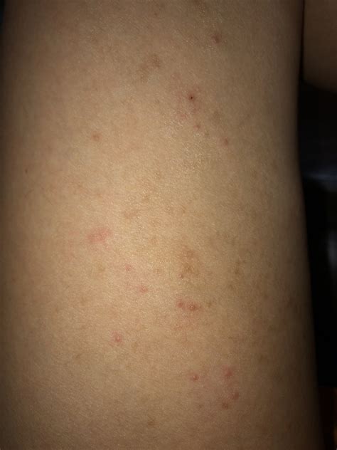 Help Needed To Identify Skin Rash Condition